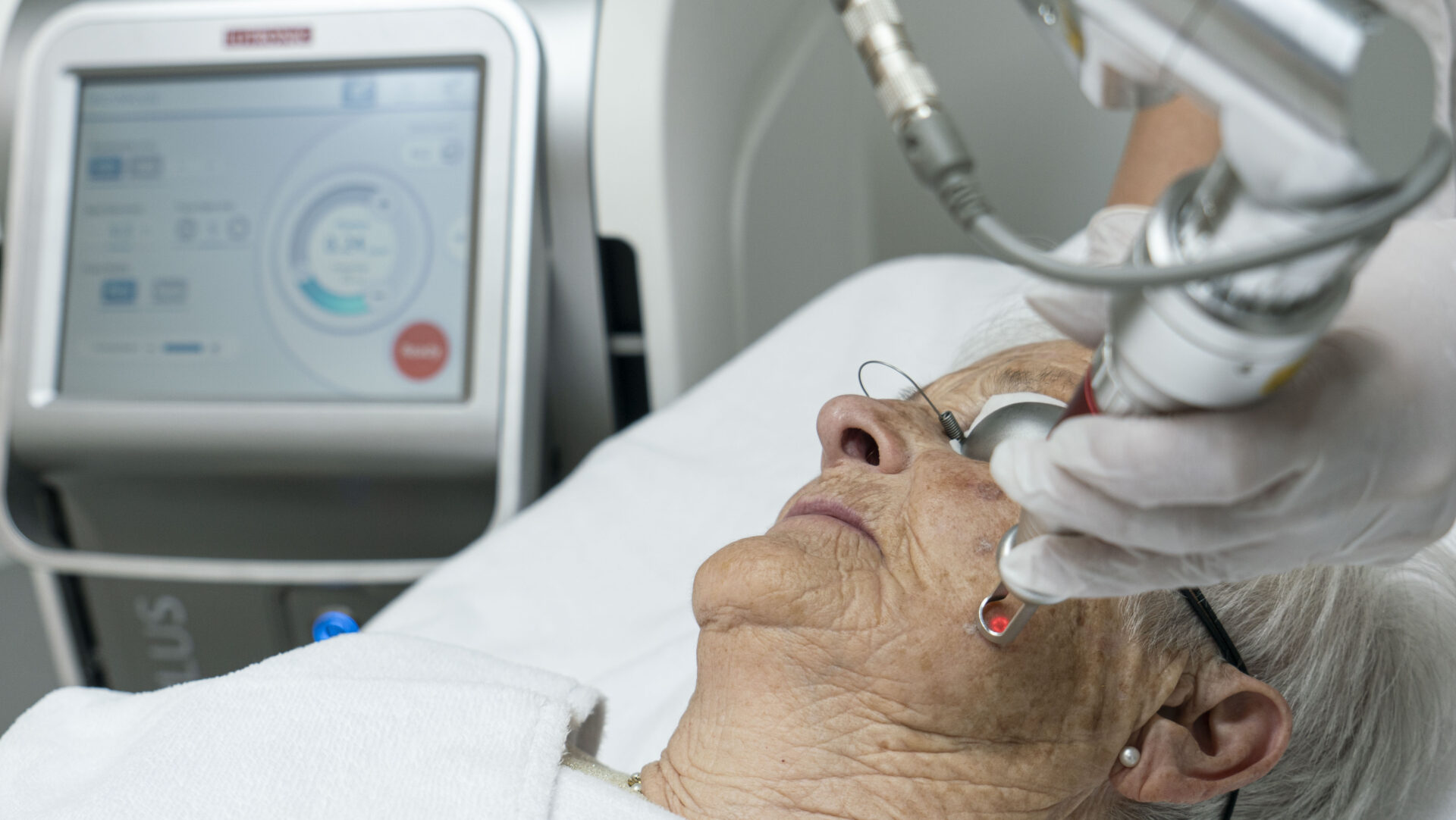 skincenters laserbehandeling pigment