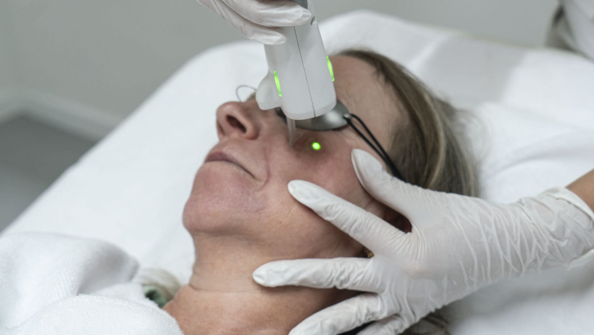 couperose behandeling