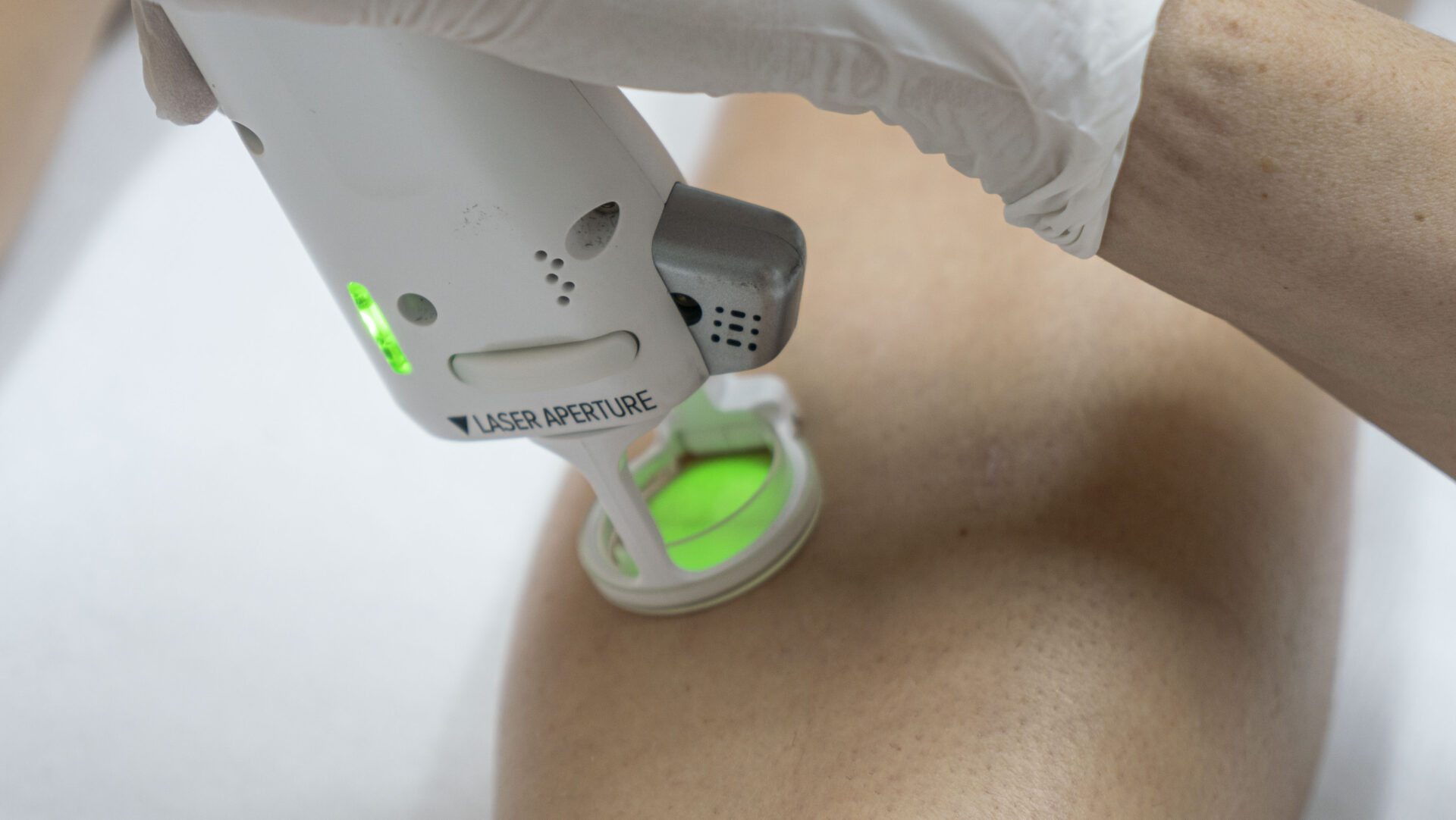 laserontharing onderbenen