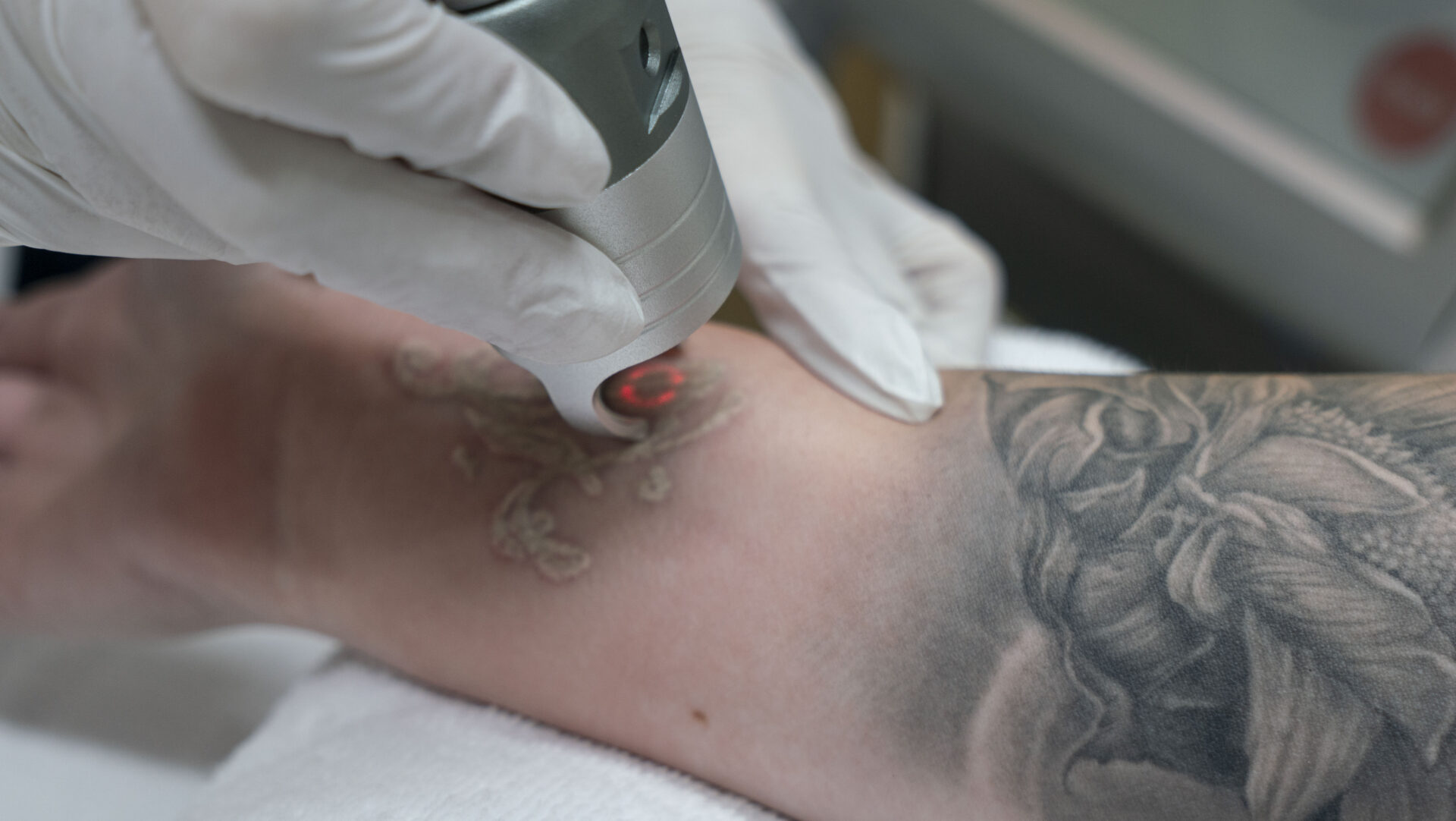 nazorg tattoo removal