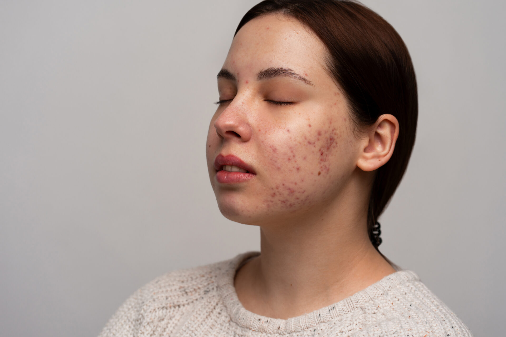 rosacea