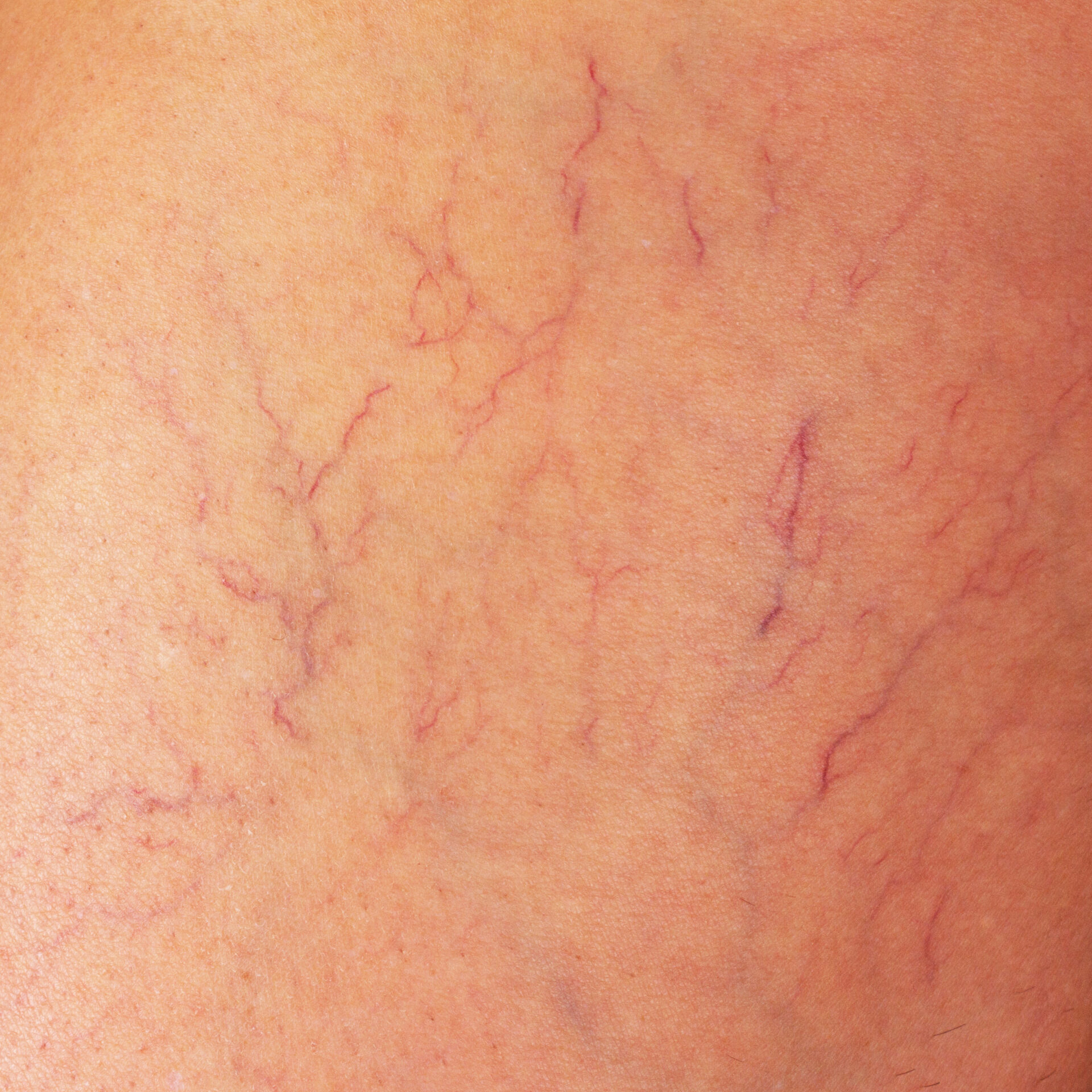 spider veins